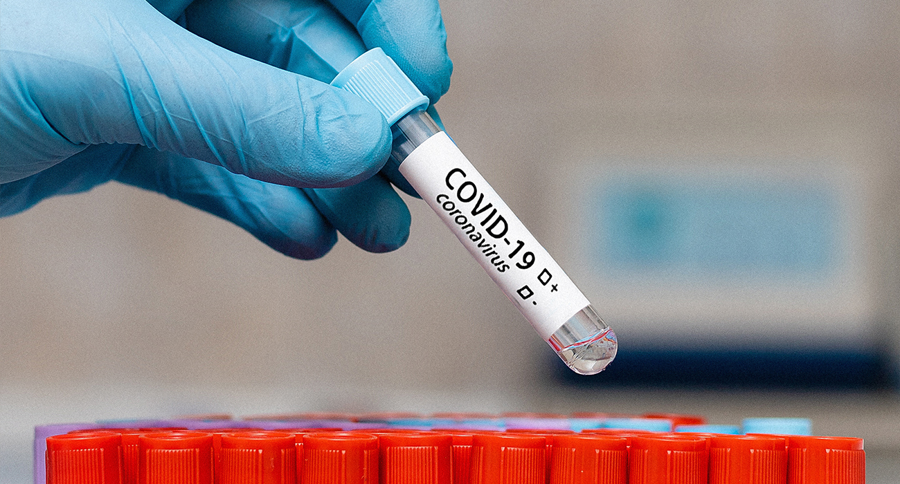 Анализ на коронавирус (COVID-19)